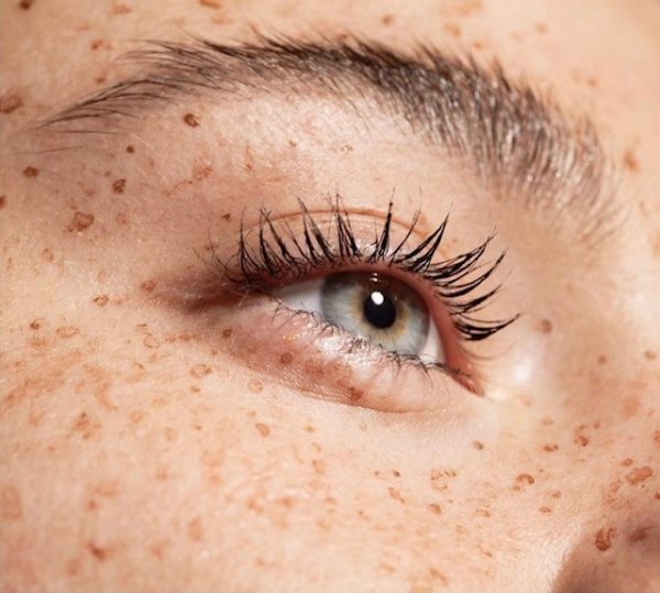 Freckle Face